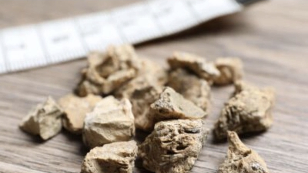 Kanadalı alimlərdən böyrək daşlarına qarşı YENİ ÇARƏ