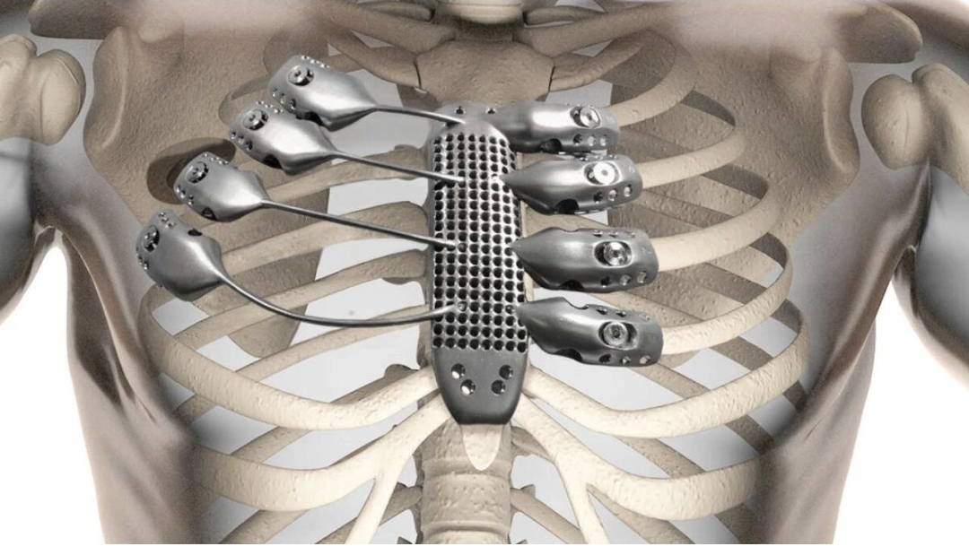 Zədələnmiş sümüklərin sürətli bərpasına imkan verən cihaz yaradılıb
